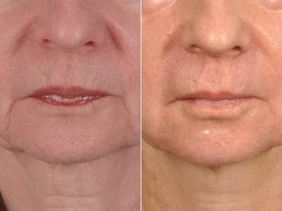 Microneedling Before & After Gallery - Patient 389541 - Image 1
