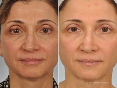 Microneedling Before & After Gallery - Patient 724275 - Image 1