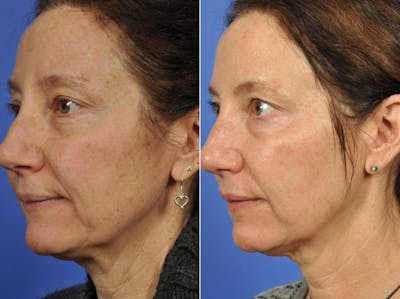 Microneedling Before & After Gallery - Patient 598061 - Image 1