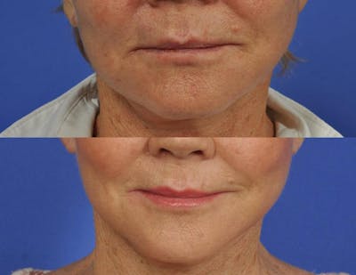 Microneedling Before & After Gallery - Patient 598061 - Image 3