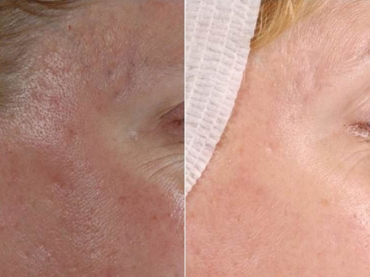 Microneedling Before & After Gallery - Patient 655029 - Image 1