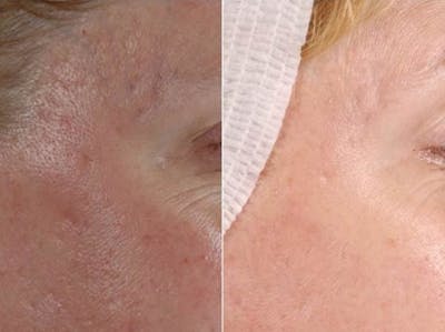 Microneedling Before & After Gallery - Patient 655029 - Image 1