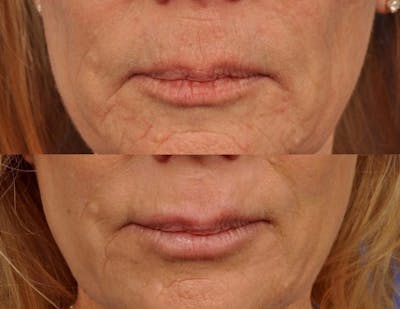 Microneedling Before & After Gallery - Patient 781670 - Image 1