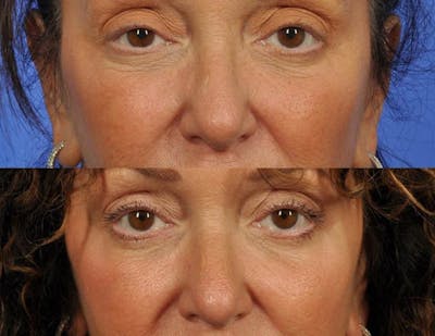 Microneedling Before & After Gallery - Patient 852089 - Image 1