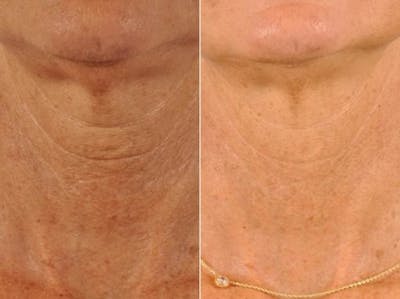 Neck Firming Before & After Gallery - Patient 112170 - Image 3