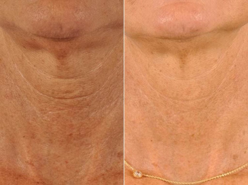 Neck Firming Before & After Gallery - Patient 112170 - Image 3