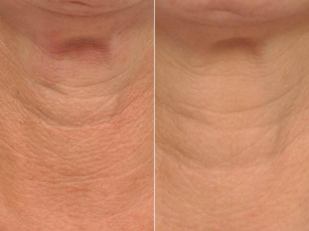 Neck Firming Before & After Gallery - Patient 112170 - Image 4