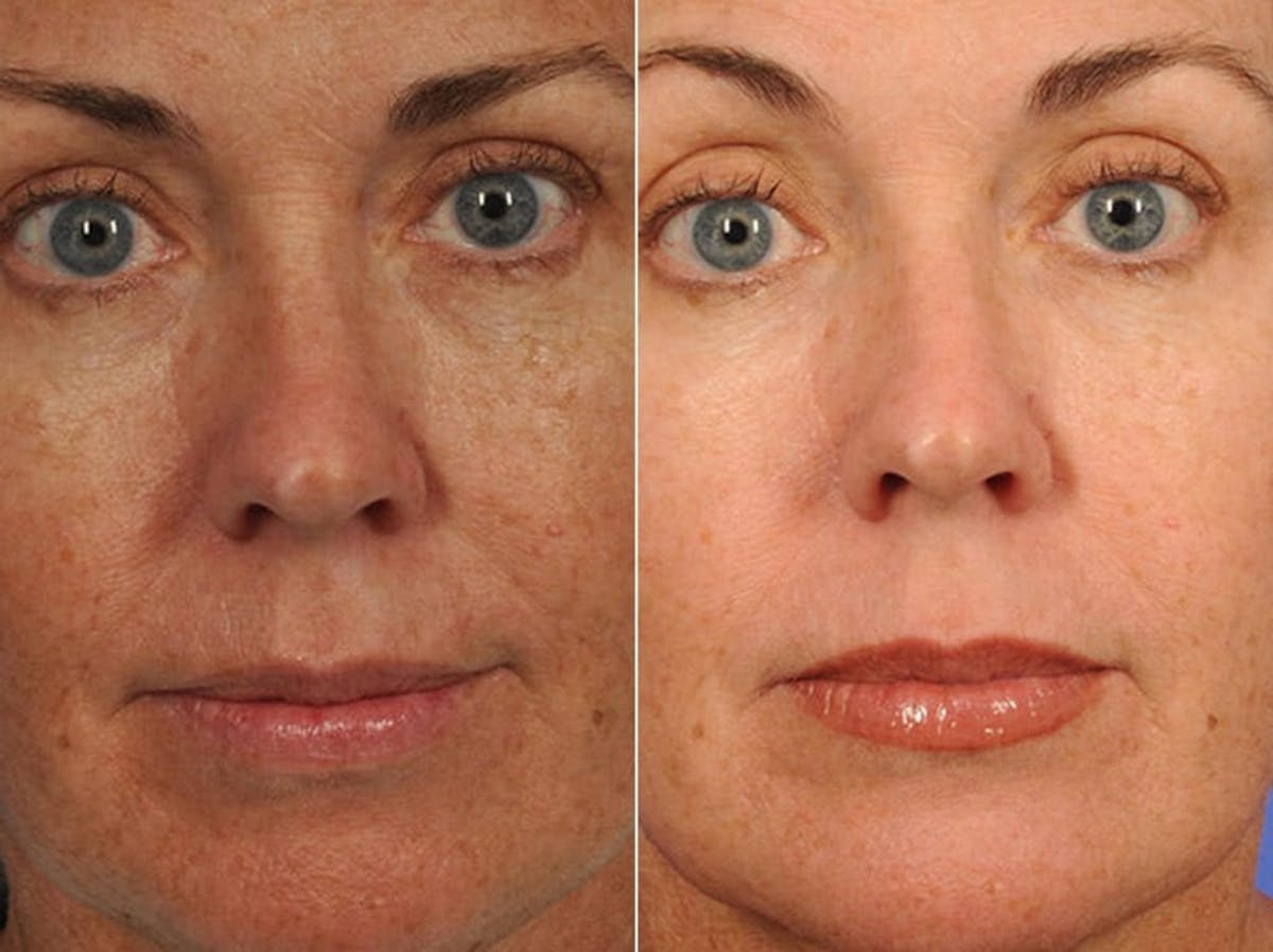 Peels and Microdermabrasion Before & After Gallery - Patient 115404 - Image 1