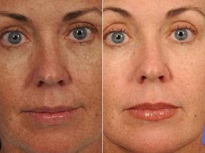 Peels and Microdermabrasion Before & After Gallery - Patient 115404 - Image 1