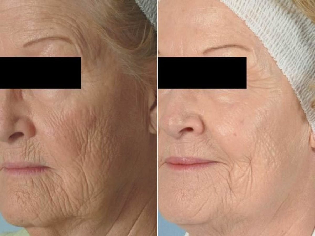 Peels and Microdermabrasion Before & After Gallery - Patient 105602 - Image 1