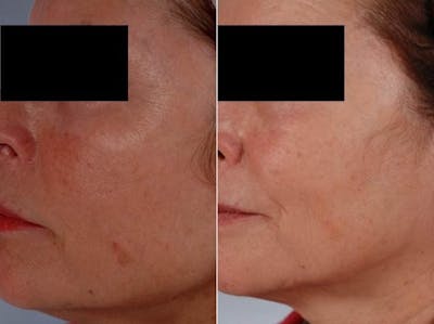 Peels and Microdermabrasion Before & After Gallery - Patient 177677 - Image 1