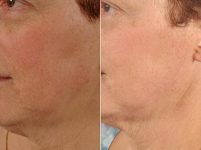Peels and Microdermabrasion Before & After Gallery - Patient 401124 - Image 2