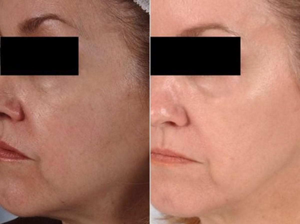 Peels and Microdermabrasion Before & After Gallery - Patient 411640 - Image 1