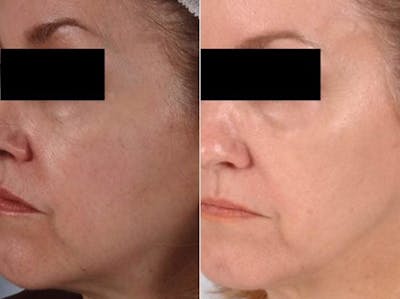 Peels and Microdermabrasion Before & After Gallery - Patient 411640 - Image 1