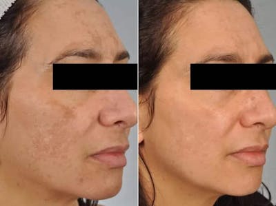 Peels and Microdermabrasion Before & After Gallery - Patient 163799 - Image 2