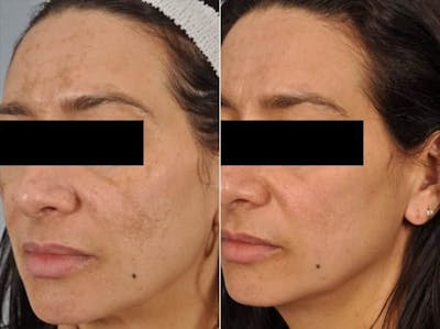 Peels and Microdermabrasion Before & After Gallery - Patient 163799 - Image 3