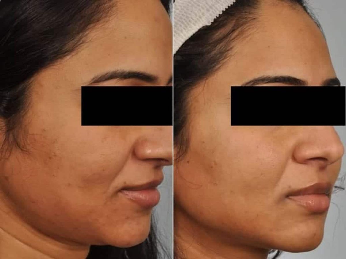 Peels and Microdermabrasion Before & After Gallery - Patient 329457 - Image 1