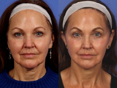 Radiofrequency Microneedling (Morpheus8) Before & After Gallery - Patient 358658 - Image 1