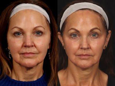 Radiofrequency Microneedling (Morpheus8) Before & After Gallery - Patient 358658 - Image 2