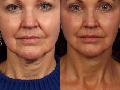 Radiofrequency Microneedling (Morpheus8) Before & After Gallery - Patient 358658 - Image 4