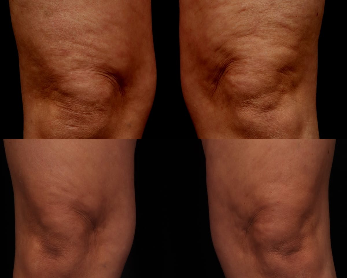 Radiofrequency Microneedling (Morpheus8) Before & After Gallery - Patient 219830 - Image 1