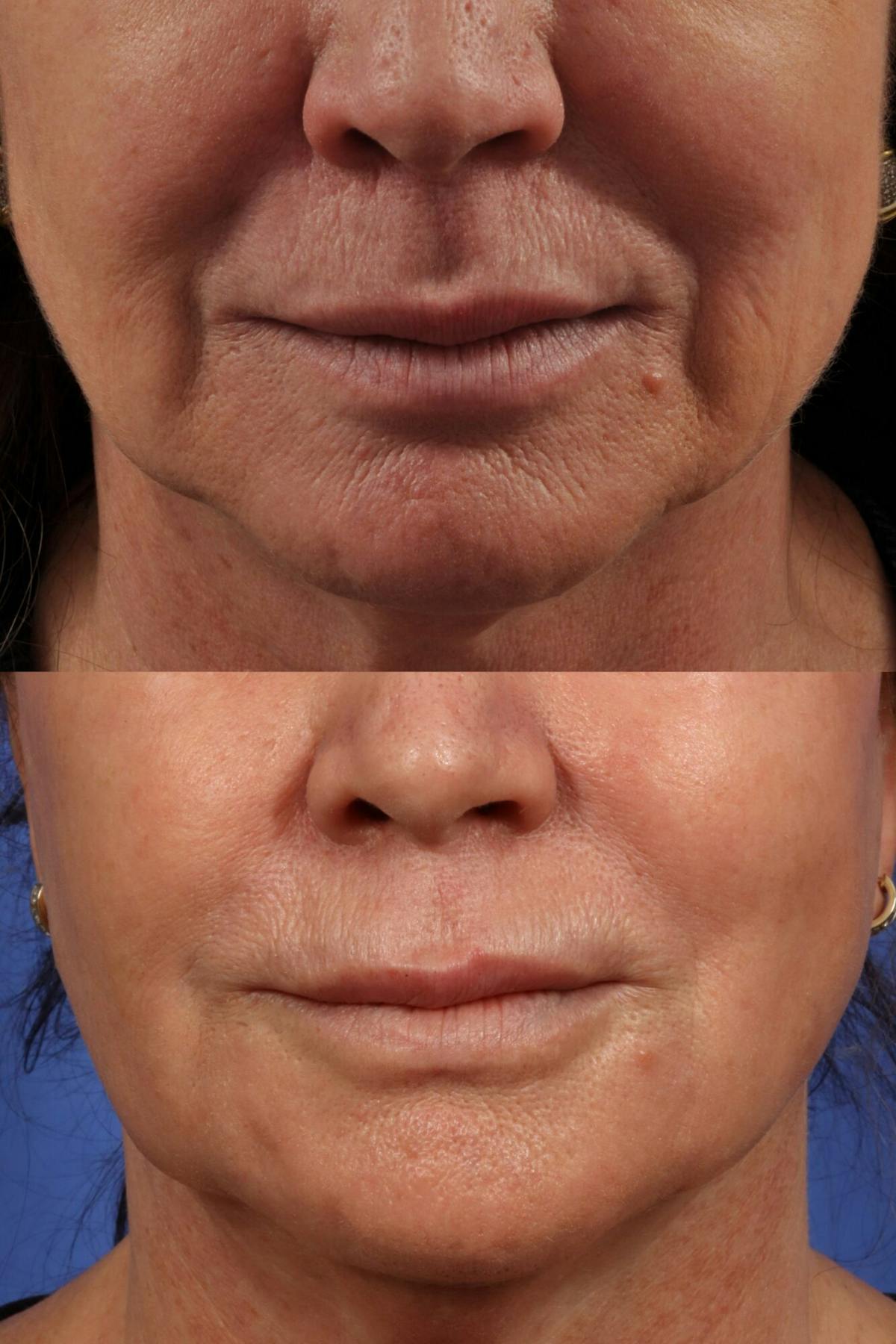 Radiofrequency Microneedling (Morpheus8) Before & After Gallery - Patient 147353 - Image 1
