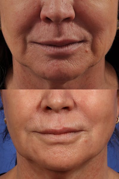 Radiofrequency Microneedling (Morpheus8) Before & After Gallery - Patient 147353 - Image 1