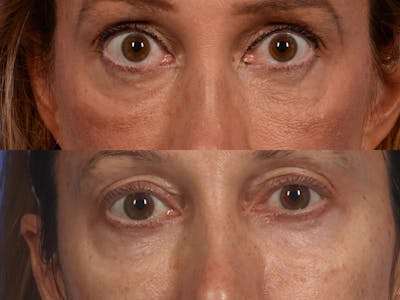 Radiofrequency Microneedling (Morpheus8) Before & After Gallery - Patient 151881 - Image 1