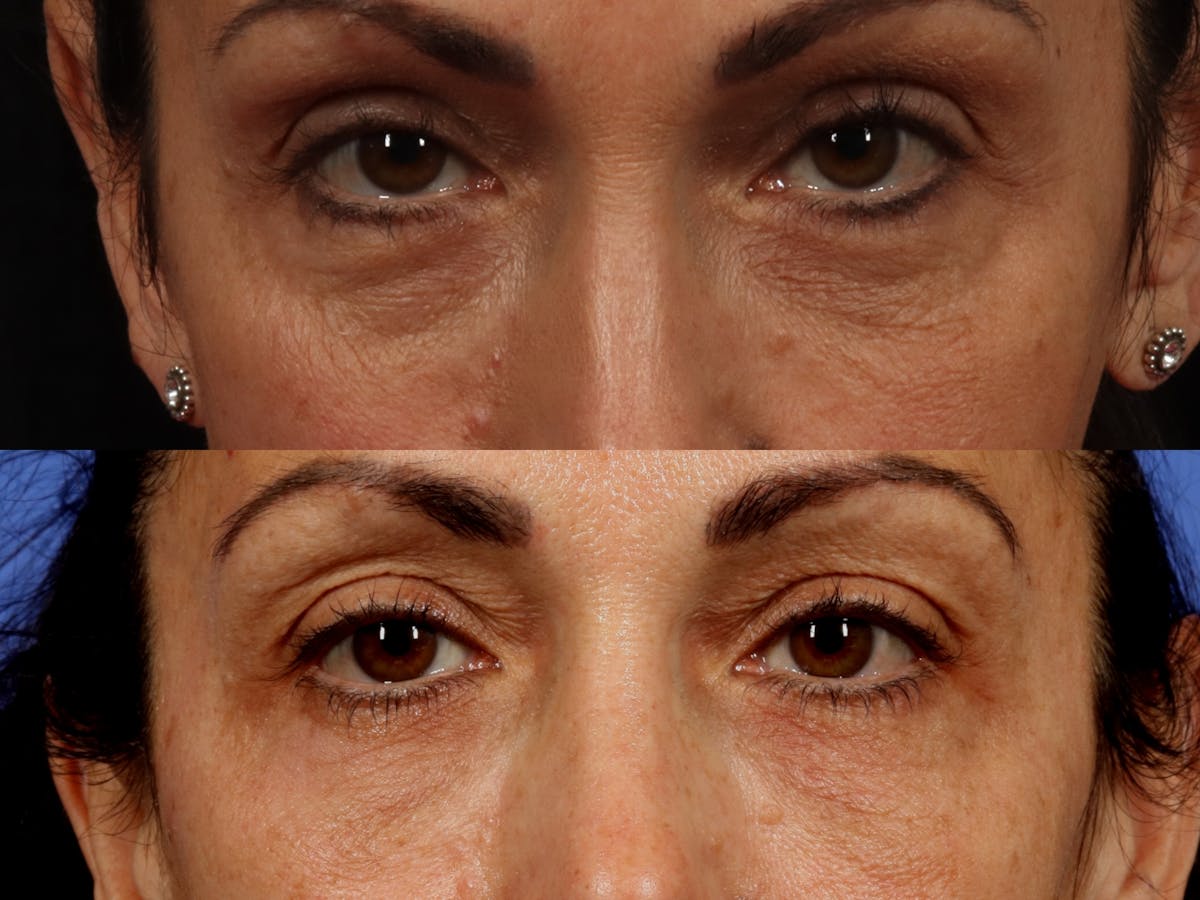 Radiofrequency Microneedling (Morpheus8) Before & After Gallery - Patient 409760 - Image 1