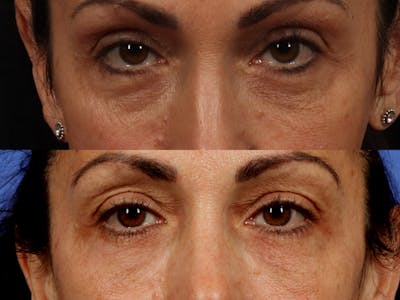 Radiofrequency Microneedling (Morpheus8) Before & After Gallery - Patient 409760 - Image 1