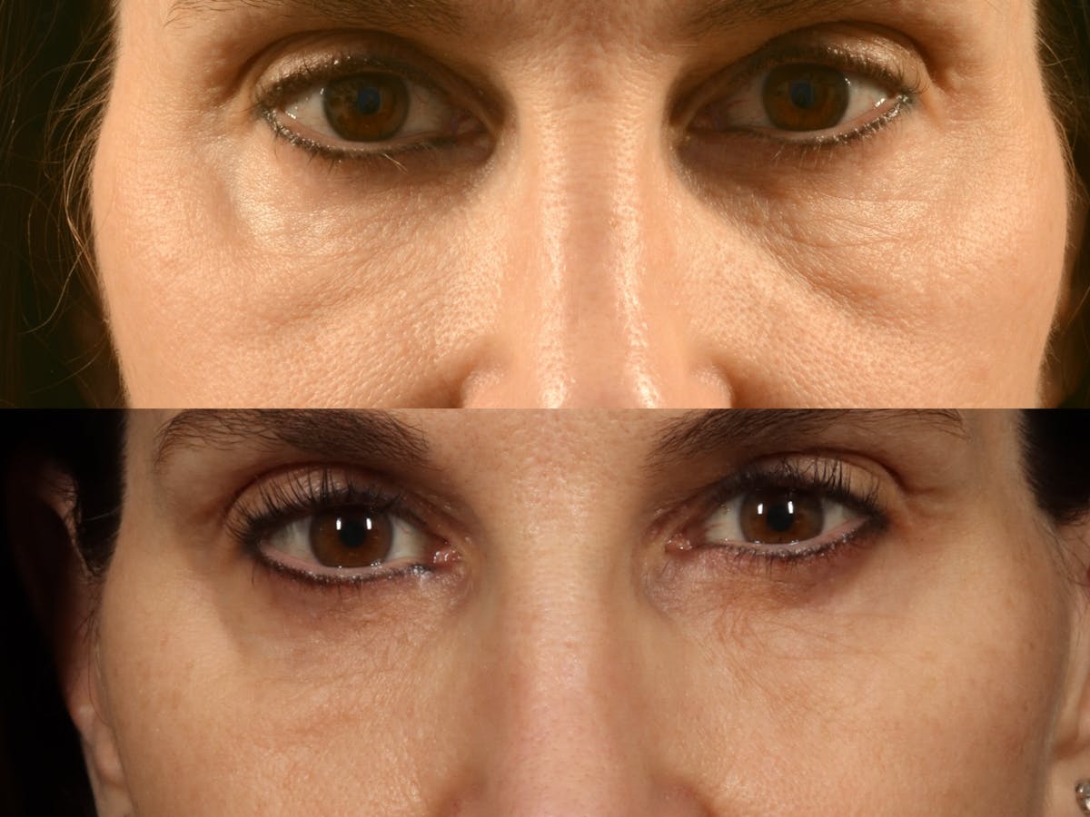 Radiofrequency Microneedling (Morpheus8) Before & After Gallery - Patient 991049 - Image 1