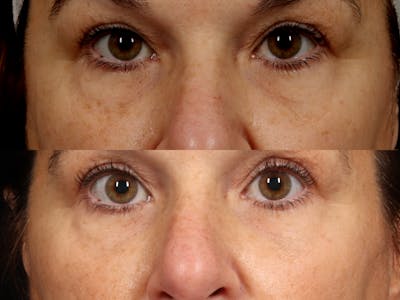 Radiofrequency Microneedling (Morpheus8) Before & After Gallery - Patient 250952 - Image 1