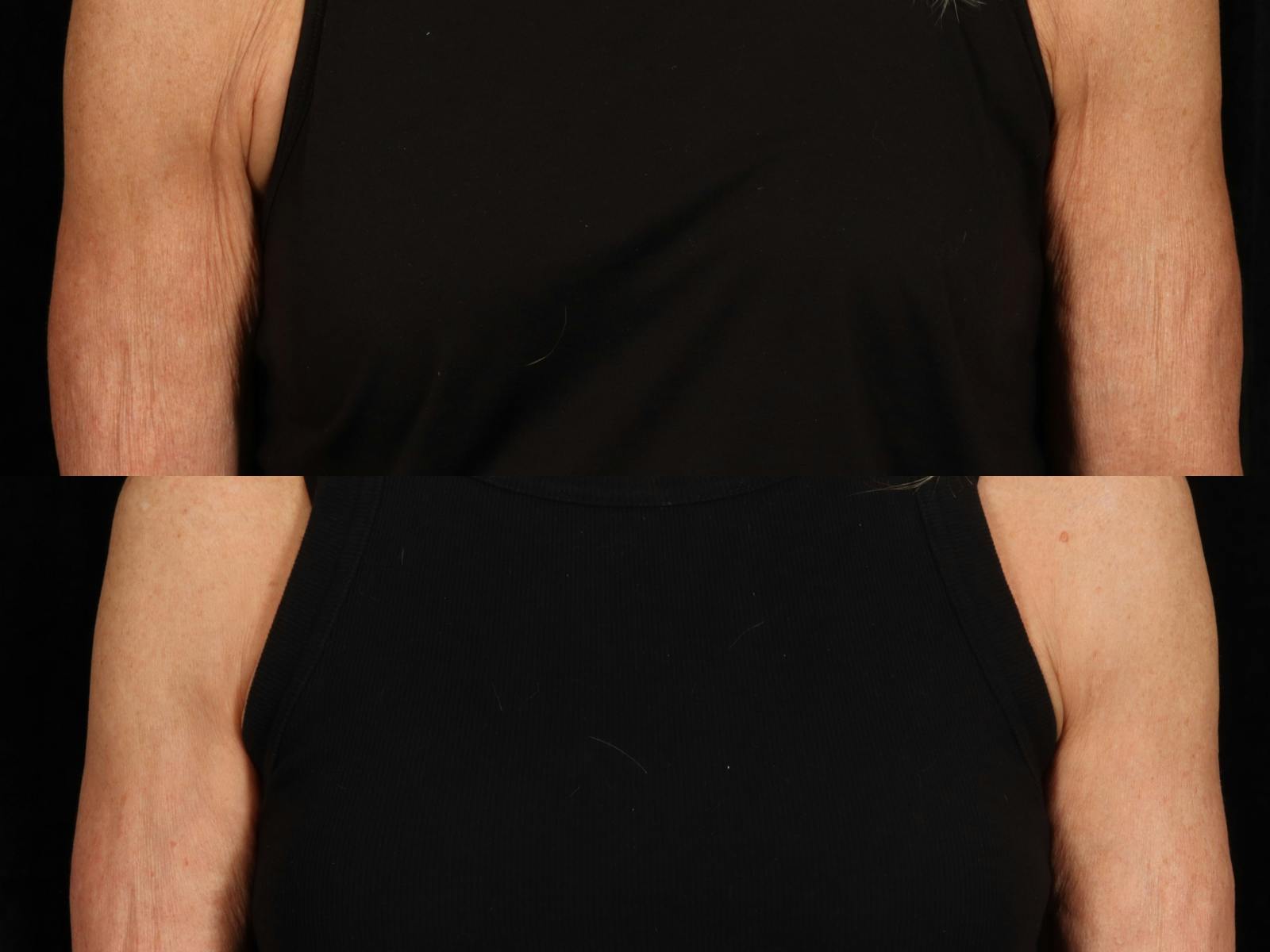 Radiofrequency Microneedling (Morpheus8) Before & After Gallery - Patient 128555 - Image 1