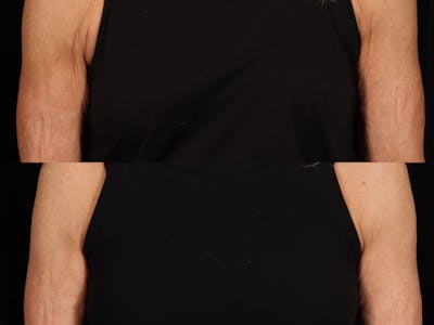 Radiofrequency Microneedling (Morpheus8) Before & After Gallery - Patient 128555 - Image 1