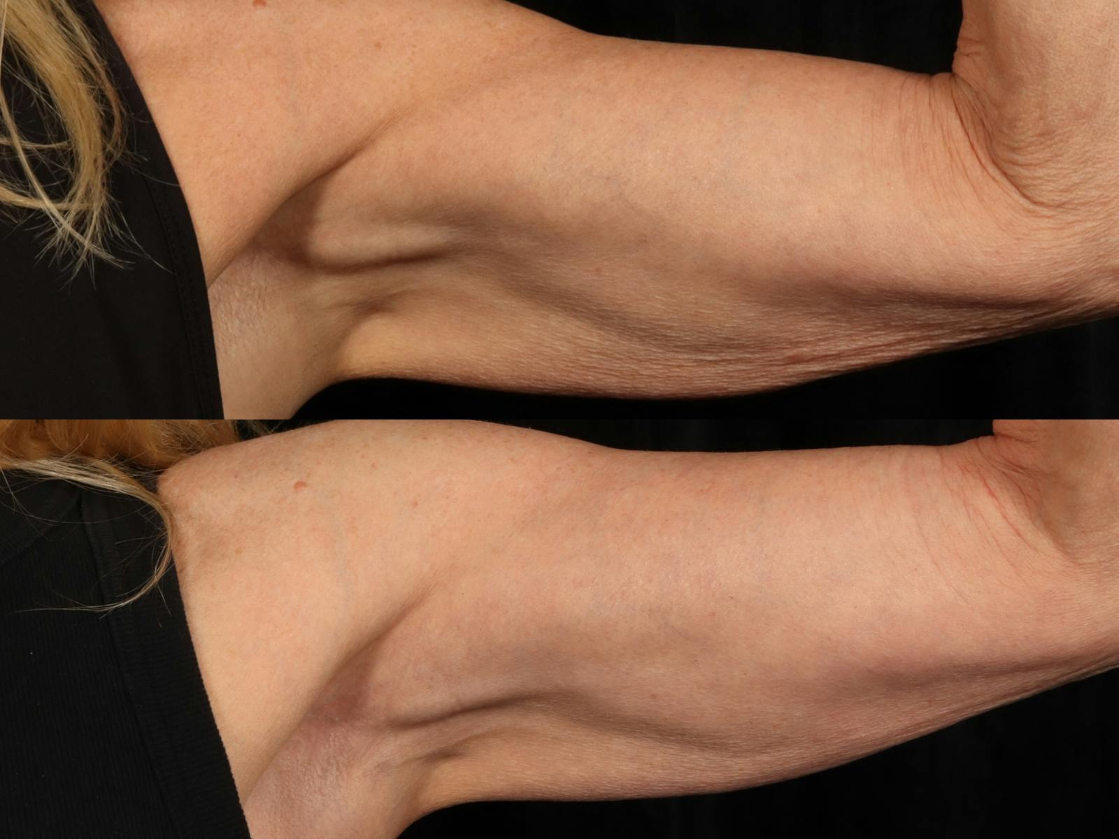 Radiofrequency Microneedling (Morpheus8) Before & After Gallery - Patient 128555 - Image 2