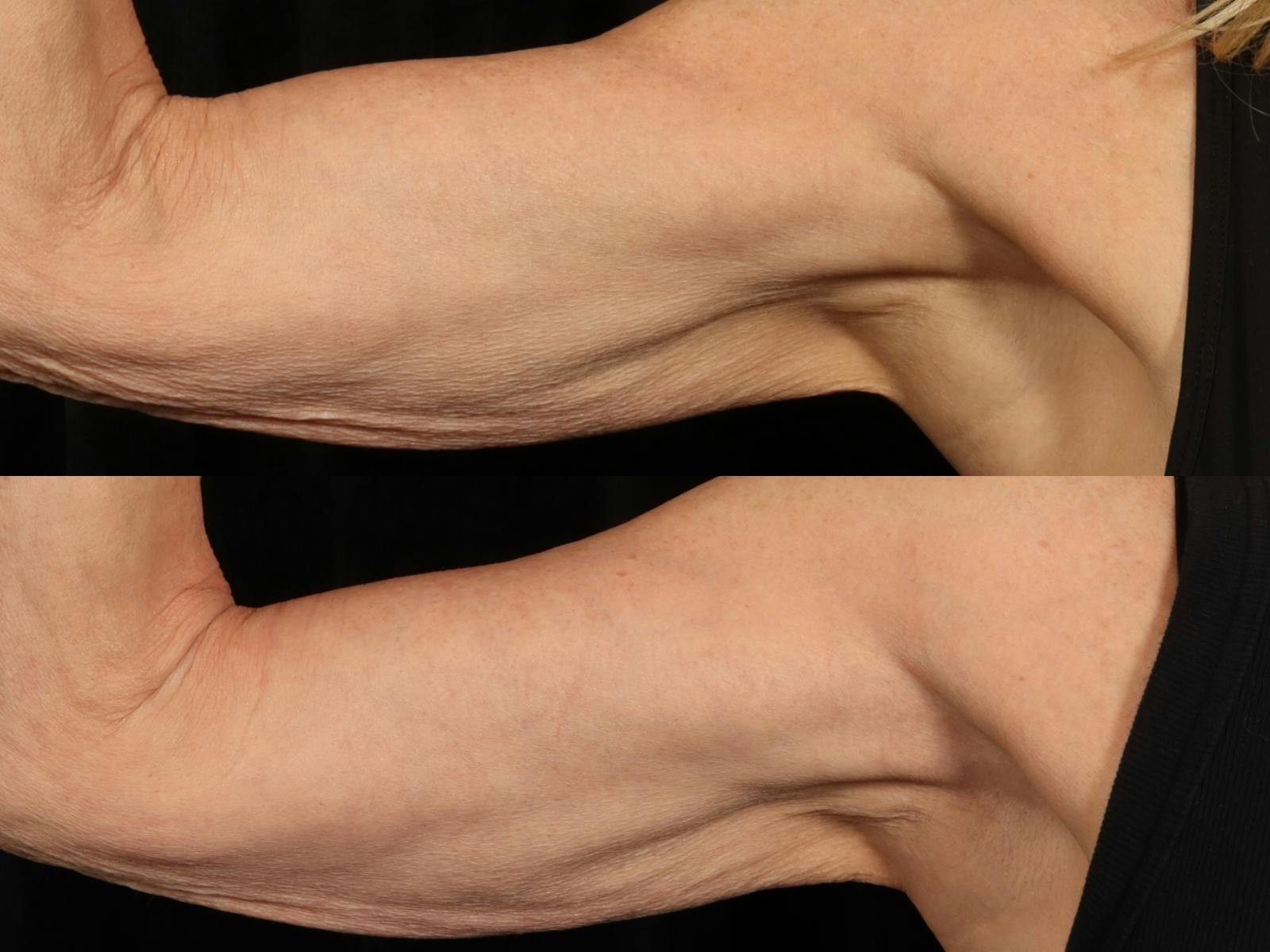 Radiofrequency Microneedling (Morpheus8) Before & After Gallery - Patient 128555 - Image 3