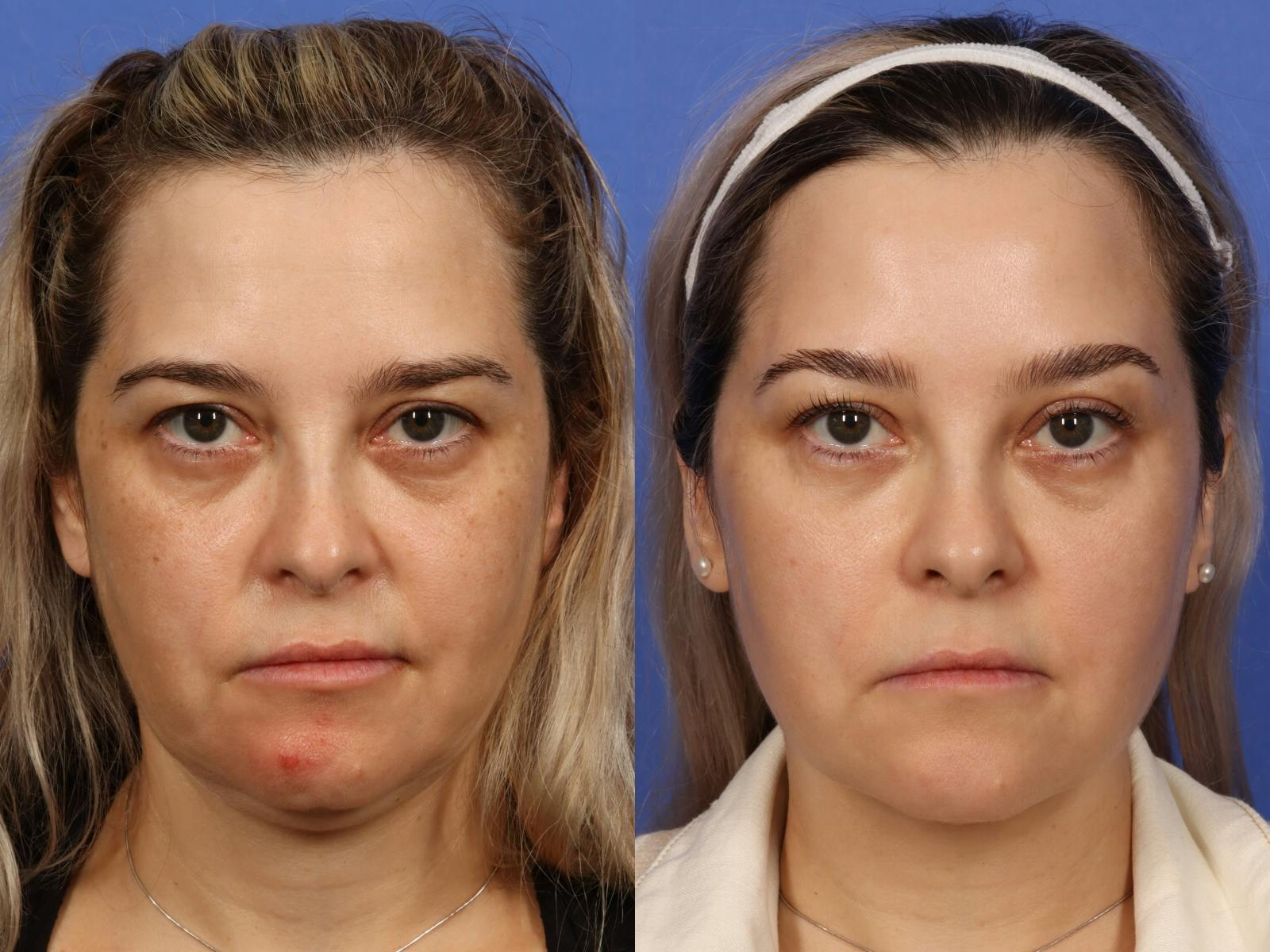 Radiofrequency Microneedling (Morpheus8) Before & After Gallery - Patient 312652 - Image 1