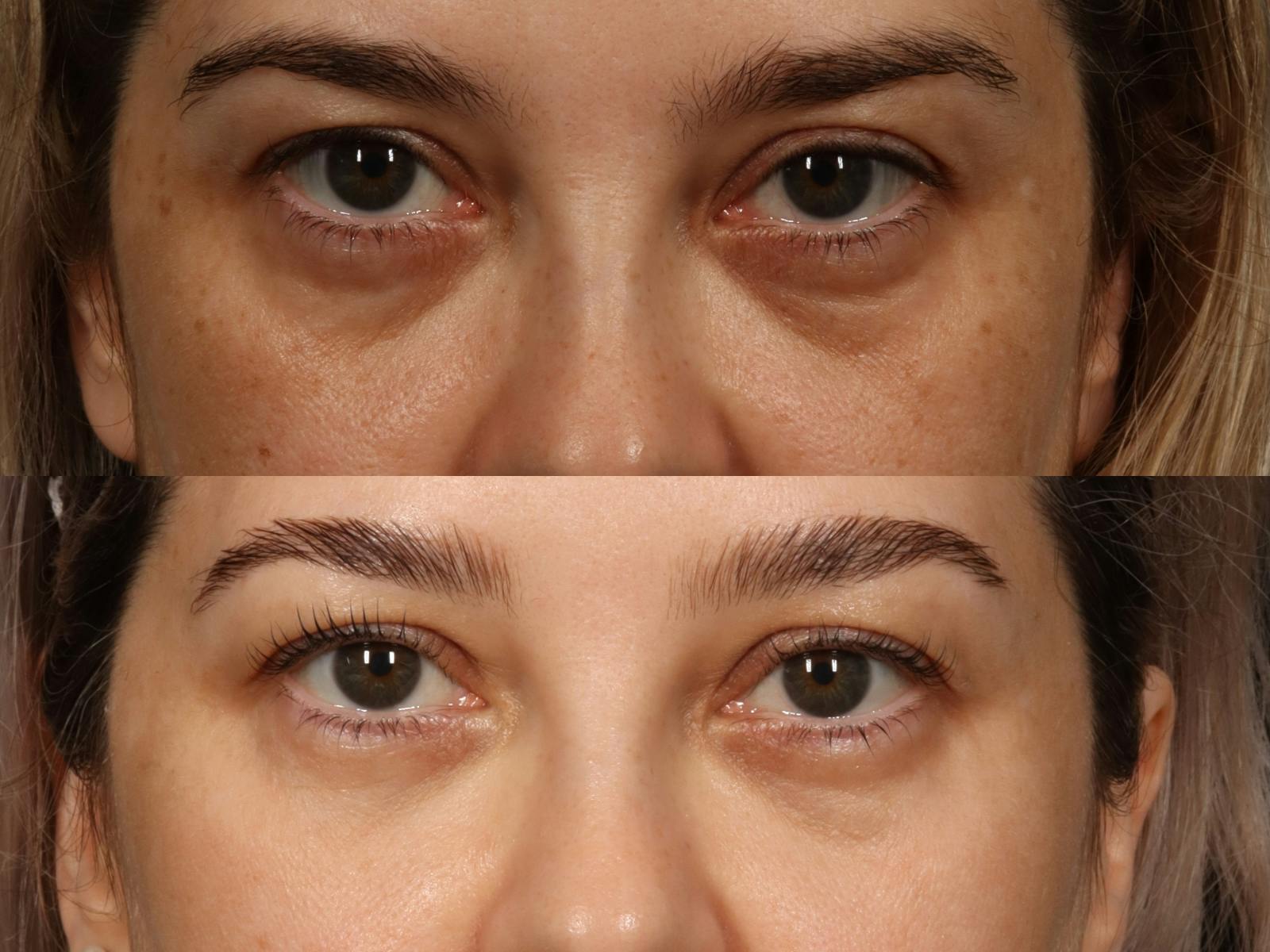 Radiofrequency Microneedling (Morpheus8) Before & After Gallery - Patient 312652 - Image 2