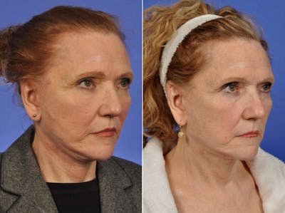 Radiofrequency Microneedling (Morpheus8) Before & After Gallery - Patient 366297 - Image 1