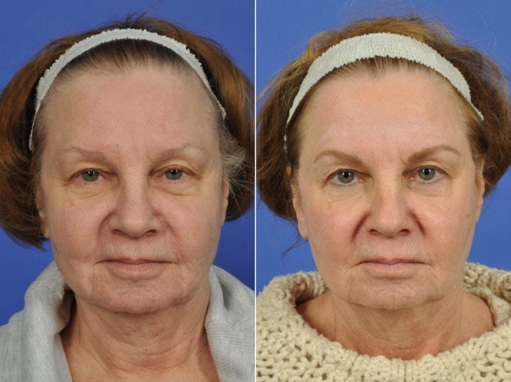 Radiofrequency Microneedling (Morpheus8) Before & After Gallery - Patient 208724 - Image 1