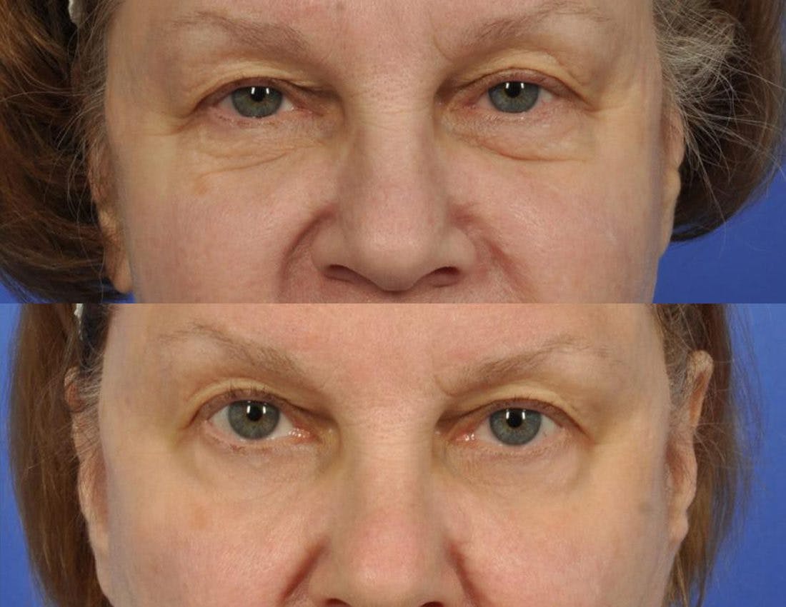 Radiofrequency Microneedling (Morpheus8) Before & After Gallery - Patient 208724 - Image 2