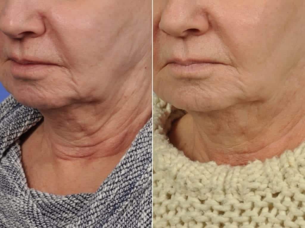 Radiofrequency Microneedling (Morpheus8) Before & After Gallery - Patient 208724 - Image 3