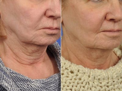 Radiofrequency Microneedling (Morpheus8) Before & After Gallery - Patient 208724 - Image 4