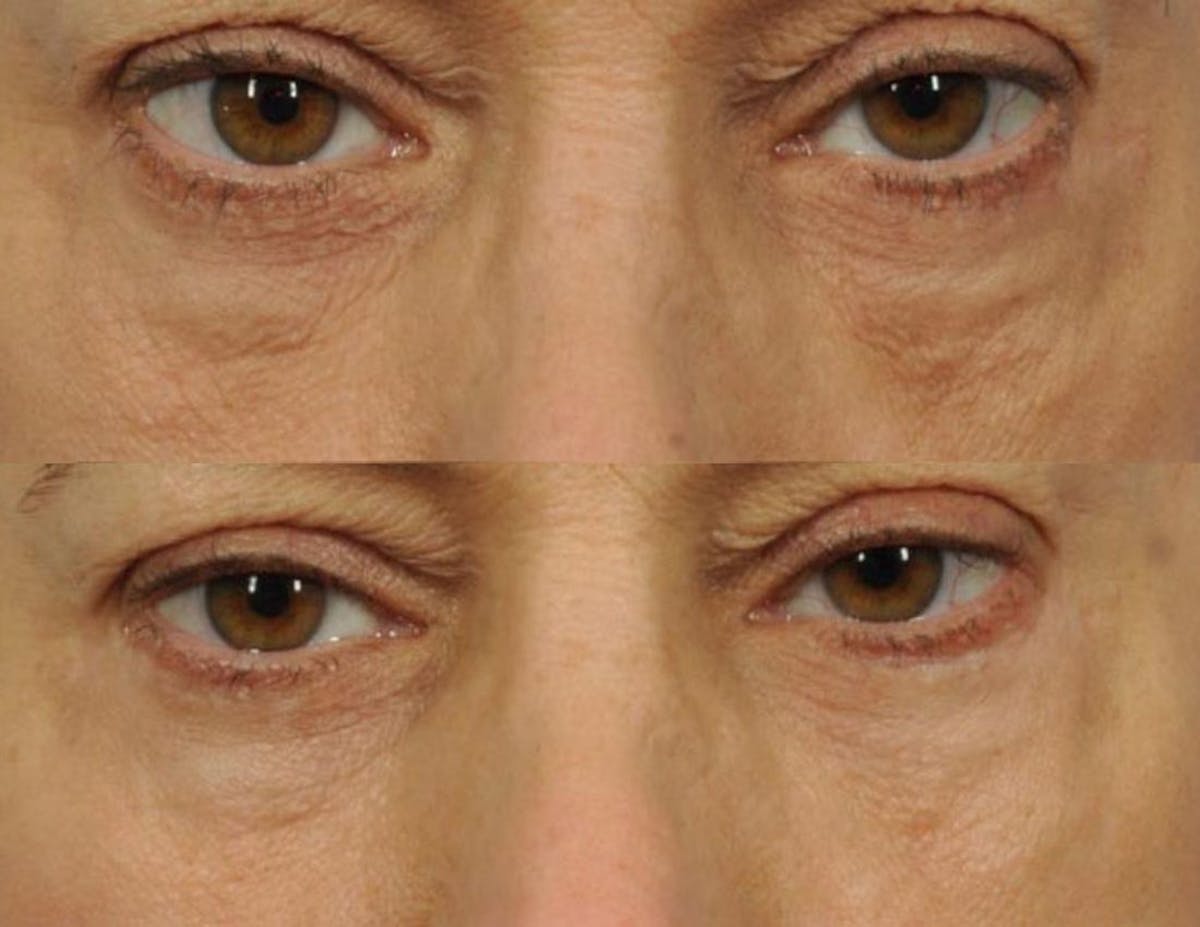 Radiofrequency Microneedling (Morpheus8) Before & After Gallery - Patient 970546 - Image 1