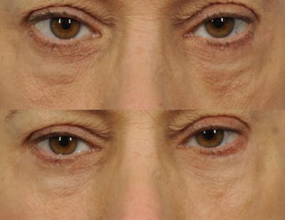 Radiofrequency Microneedling (Morpheus8) Before & After Gallery - Patient 970546 - Image 1