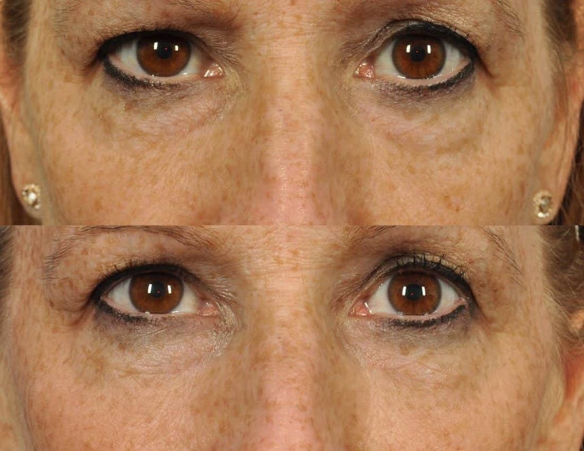 Radiofrequency Microneedling (Morpheus8) Before & After Gallery - Patient 264694 - Image 1