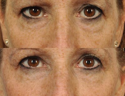 Radiofrequency Microneedling (Morpheus8) Before & After Gallery - Patient 264694 - Image 1