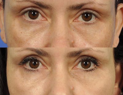 Radiofrequency Microneedling (Morpheus8) Before & After Gallery - Patient 352193 - Image 1