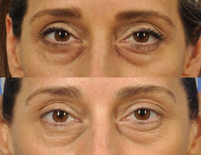 Radiofrequency Microneedling (Morpheus8) Before & After Gallery - Patient 586413 - Image 1