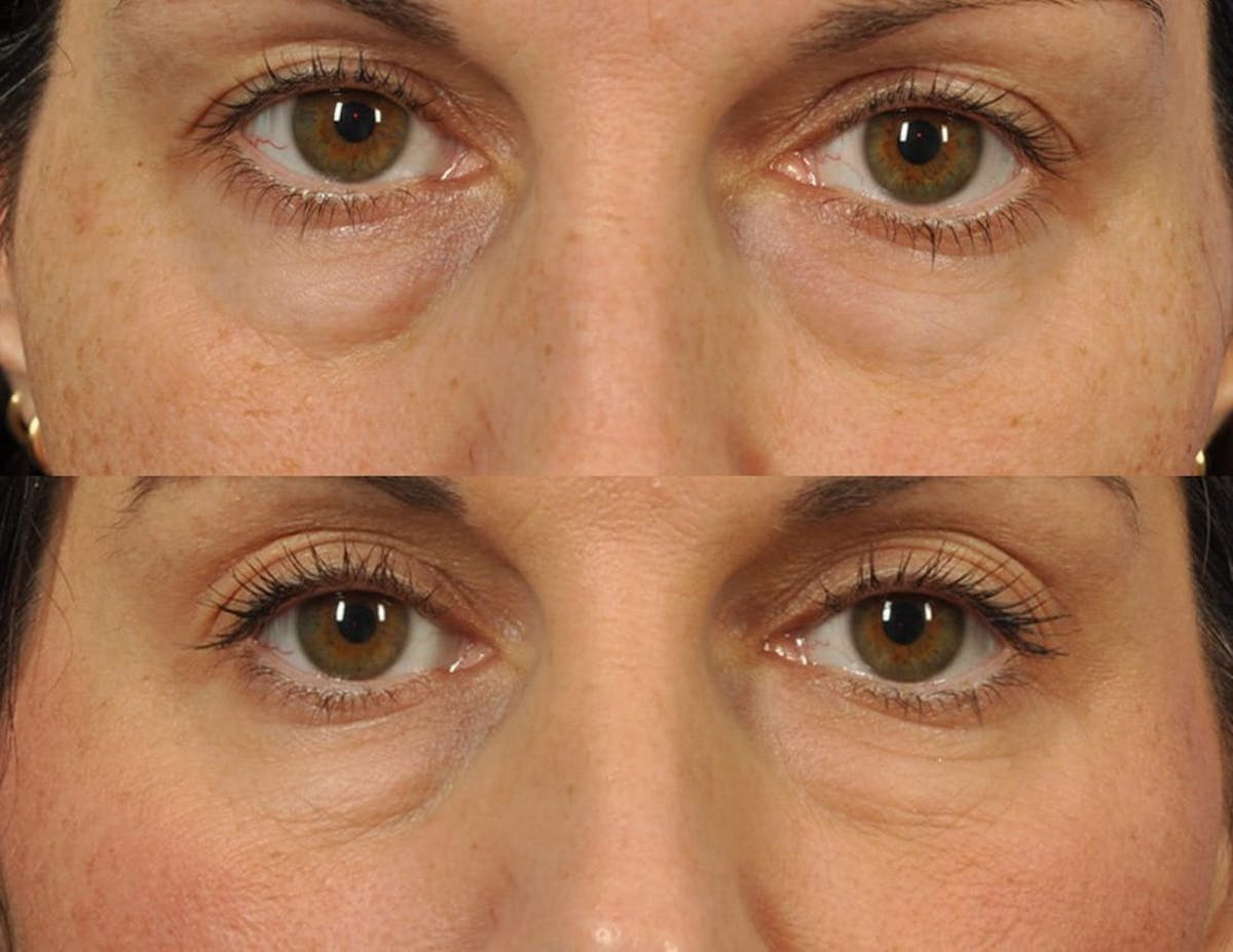 Radiofrequency Microneedling (Morpheus8) Before & After Gallery - Patient 181282 - Image 1